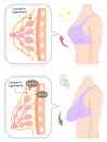 Diagram of wooman breasts with upper body. Beauty body care concept